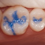 D-Tech Dental Etch Etching Gel (Dropper Pack)