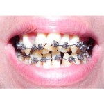 D-Tech Precimax (MIM MBT Prescription Brackets)