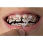 D-Tech Precimax (MIM MBT Prescription Brackets)