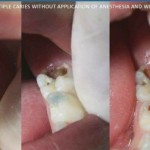 Dengen Dental Carie Fix Caries Removing Gel