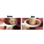 Dengen Dental Carie Fix Caries Removing Gel
