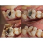 Dengen Dental Carie Fix Caries Removing Gel