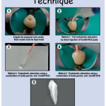 Prevest Cerafill RCS Endodontics