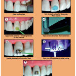 Fusion Crysta Orthodontic Adhesive Kit Orthodontics