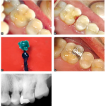 Prevest Hiflex Inlay / Crown Wax Base Plates & Waxes