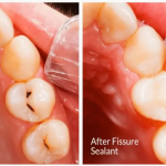 PF Seal SE Composite