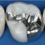 Waldent WalCap Amalgam Capsules