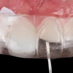 Waldent Alchem Nanoflow Zirconium Flowable Composite