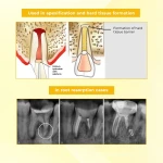 Waldent RCTpex Root Canal Filling Material (Radiopaque)