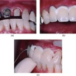 Prevest Fusion Ultra D/C