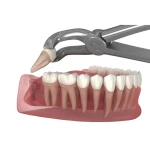GDC Extraction Forcep Lower Third Molars - 79 Standard (FX79S)