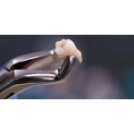GDC Extraction Forcep Lower Third Molars - 79 Standard (FX79S)