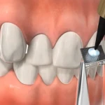 Prevest Fusion Crysta Adhesive