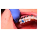 Waldent Blue Bite-Block