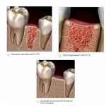 Septodont R.T.R. Syringe - Bone Graft Material