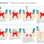 Septodont Biodentine(Single Pouch)