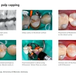 Septodont Biodentine(Single Pouch)