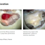 Septodont Biodentine(Single Pouch)