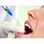 Septodont Aspirating Syringe Local anesthetic injection syringe