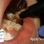 Shofu BeautiSealant Pit & Fissure Sealant