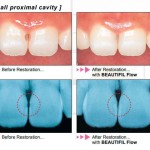 Shofu Beautifil Flow F02 Refill